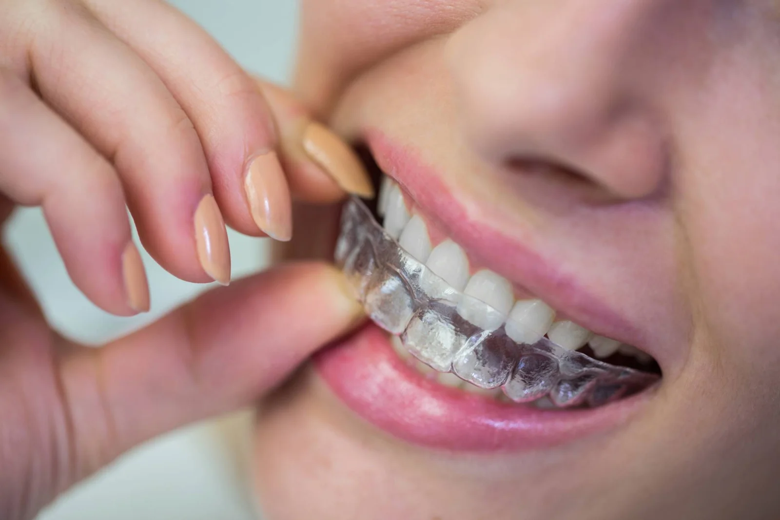 Close do sorriso de uma mulher encaixando um alinhador transparente nos dentes superiores. Tratamento ortodôntico invisível na Vila Clementino.